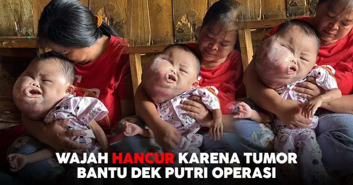 Kepala Hampir Pecah Dan Mata Buta Karena Tumor, Bantu Dek Putri Kembali Berobat Keterangan Kabar 